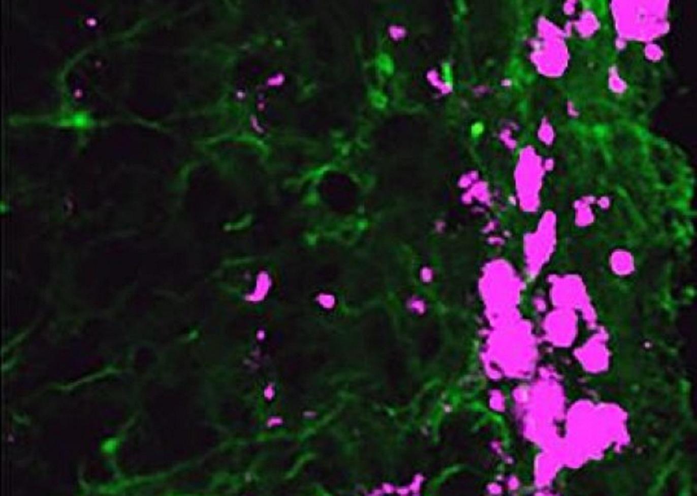 Las células reprogramadas (en verde) cazan y matan el glioblastoma (en rosa). Foto UNC.