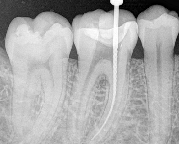 Radiografía de una endodoncia.