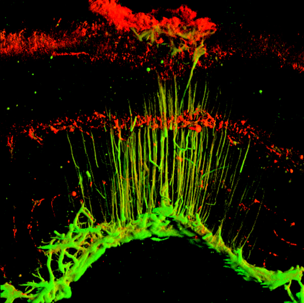 Células fotoreceptoras de la guía de Muller, verdes y alargadas, afectadas por nubes rojas de degeneración macular.