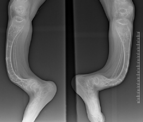 Radiografía de un paciente de osteogénesis imperfecta o síndrome de los “huesos de cristal”.